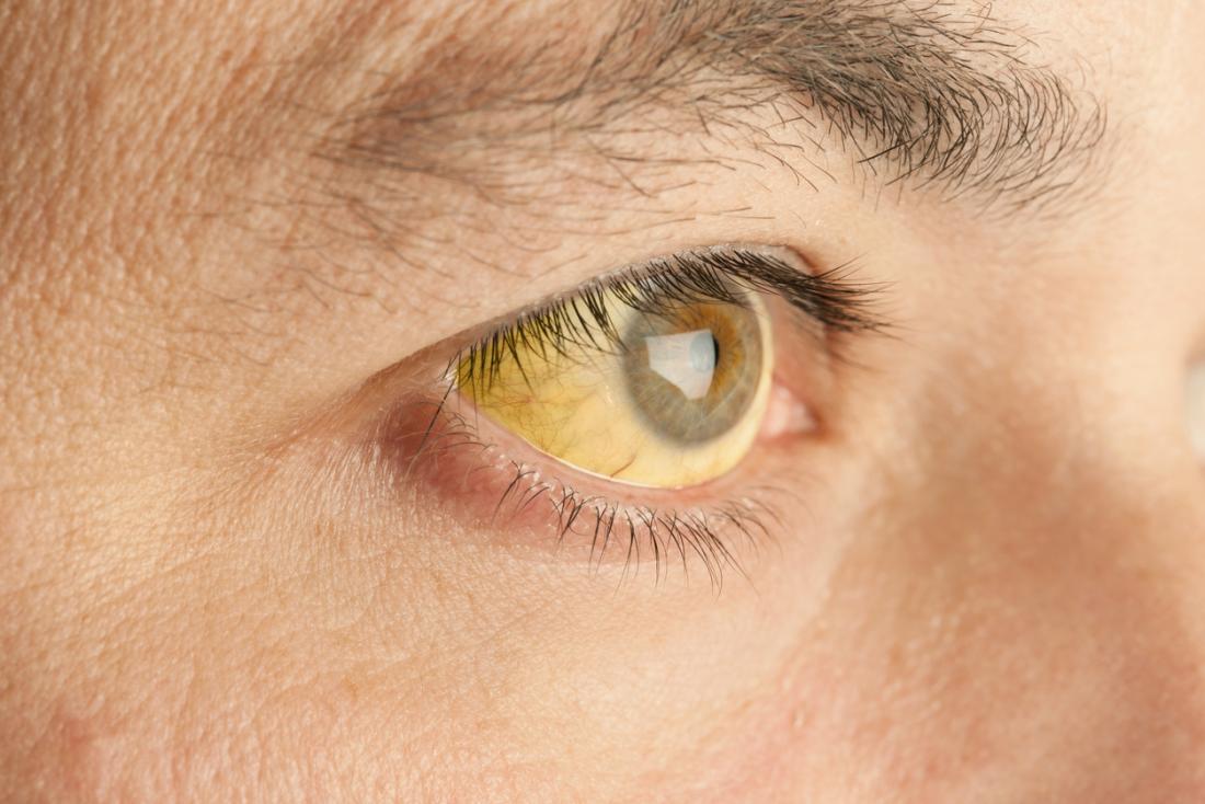 Key signs you may have yellow fever