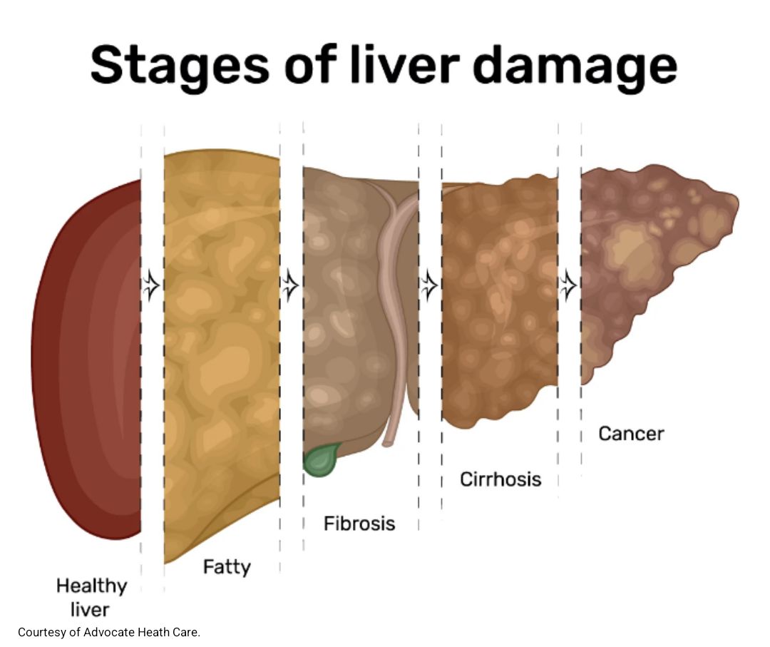 Lango: 33 men died in 2 days from liver and kidney complications 1 Adv